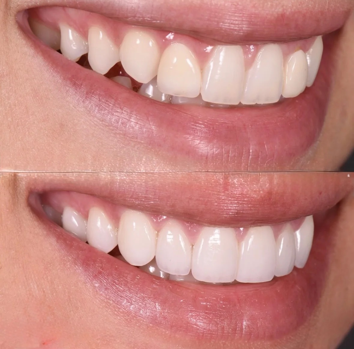 Full transformation: before treatment, uneven edges and spacing interrupted the smile line; after treatment, ultra-thin porcelain veneers with careful internal layering reflect light with the exact translucency and vitality of natural, healthy dental enamel.